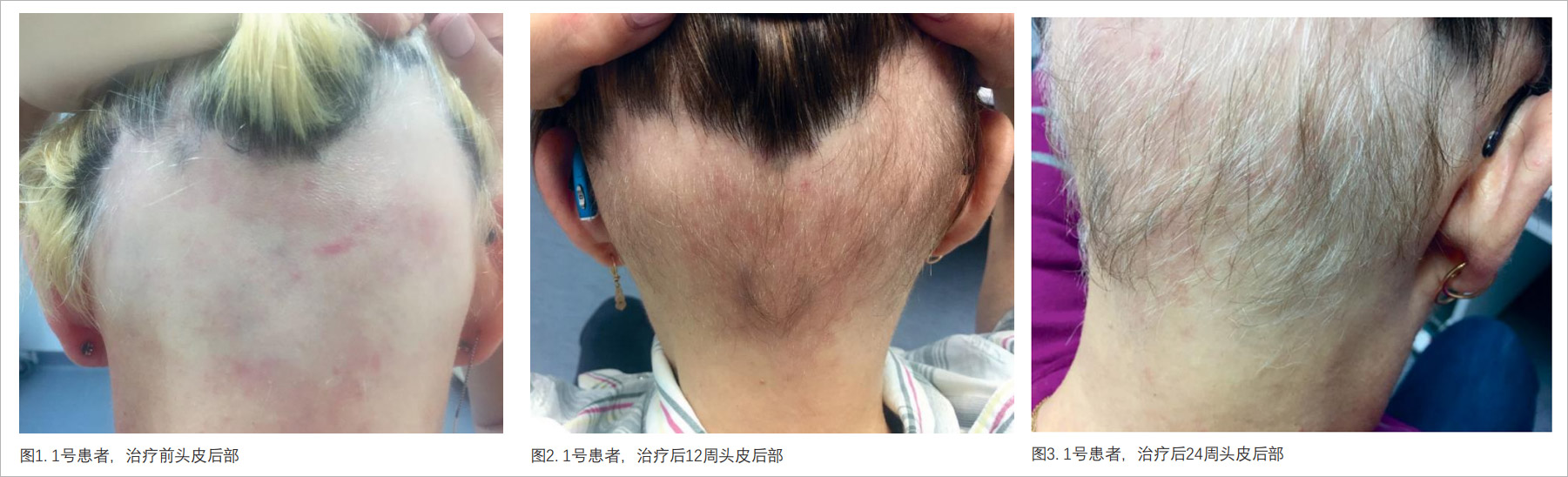 24周脱发改善79.5%，毛发再生率达到80%，干细胞治疗斑秃效果显著！