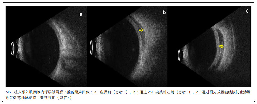 视网膜色素变性临床试验