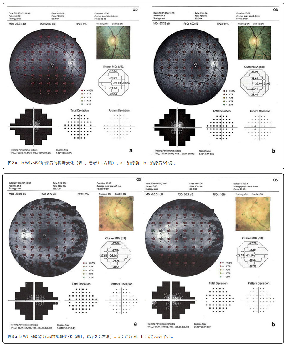 视网膜色素变性临床试验