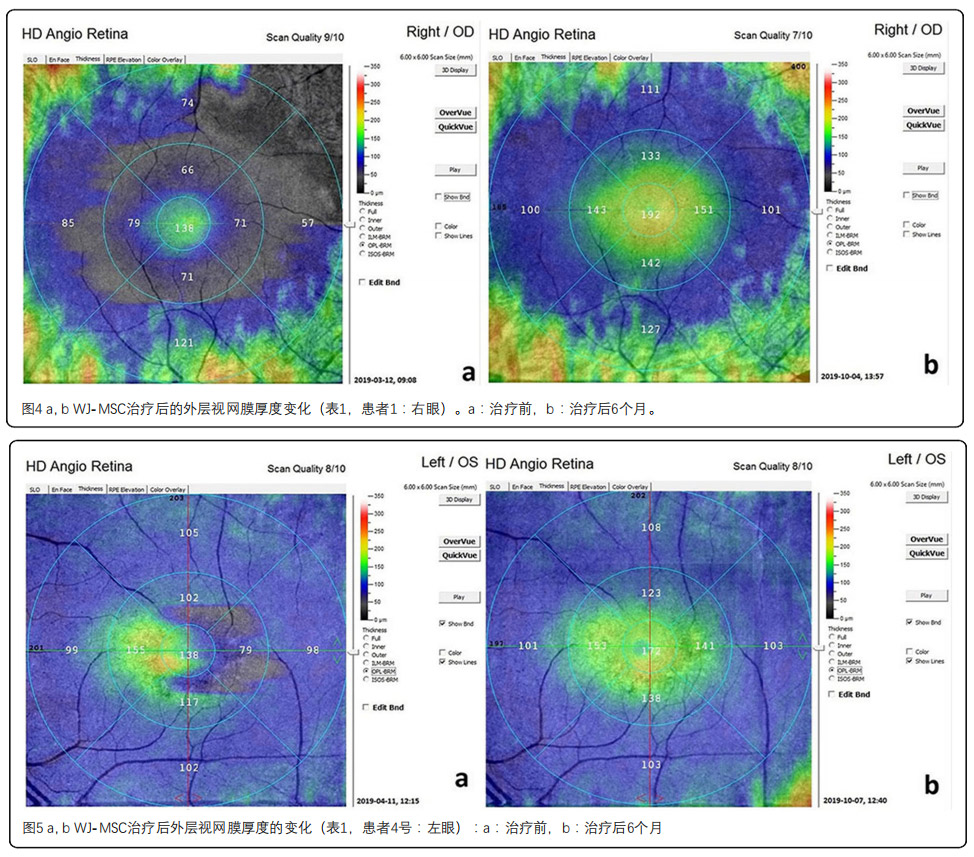 视网膜色素变性临床试验