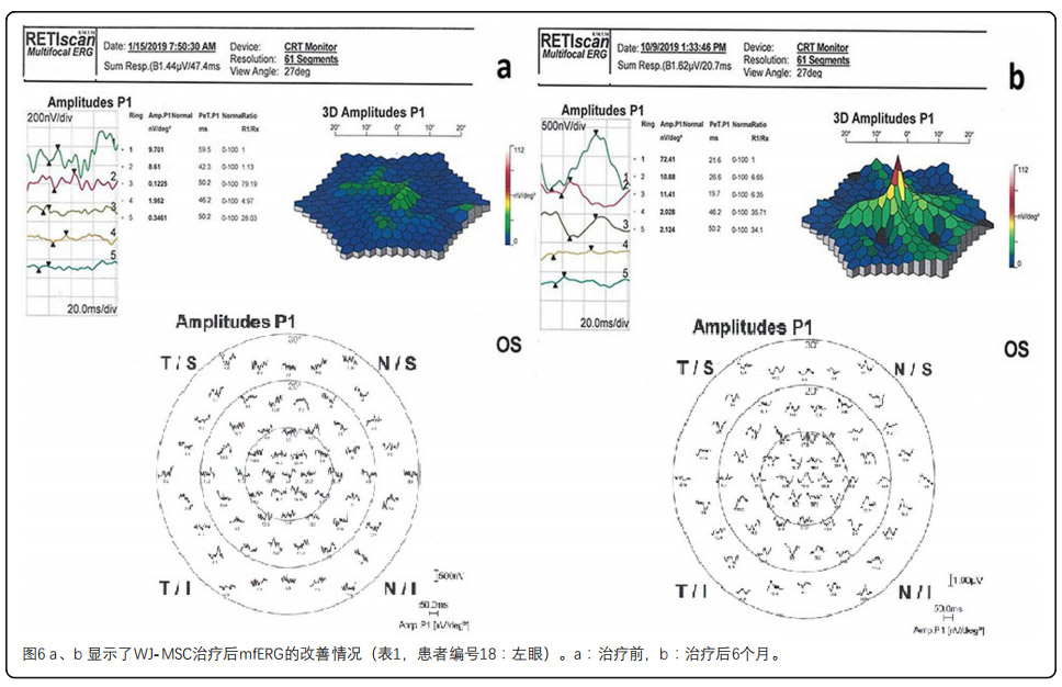 视网膜色素变性临床试验
