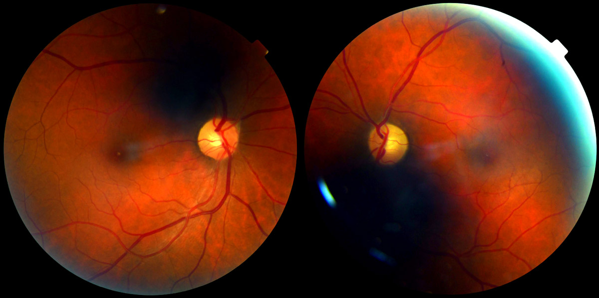 细胞疗法治疗创伤性视神经病变：最新进展、挑战与未来展望