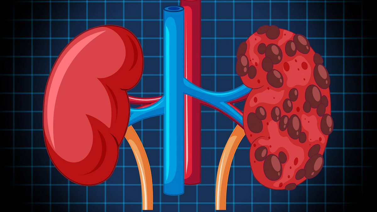 单次输注脂肪干细胞后48周，88.24%慢性肾病患者肾功能得到改善或保持稳定