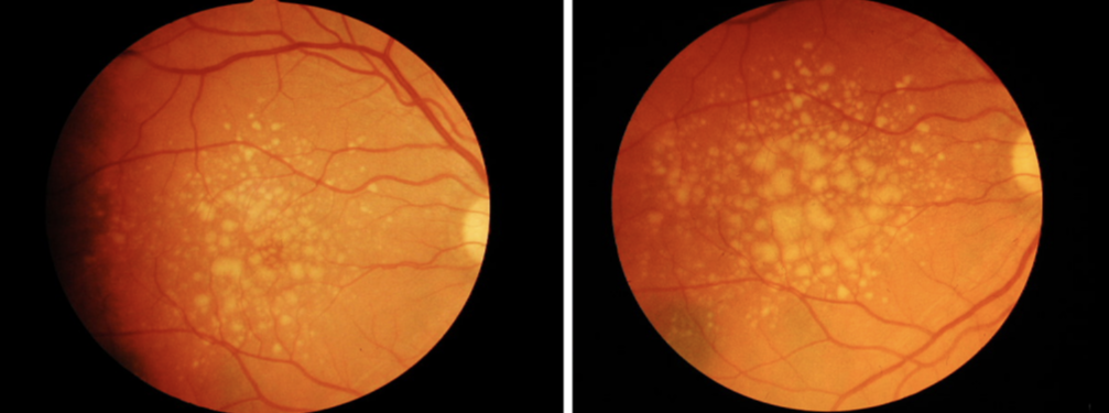 干细胞联合PRP移植后180天，患者视力和黄斑中心区视野均明显改善！干性年龄相关性黄斑变性试验报告