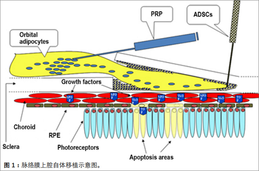 黄斑变性临床试验