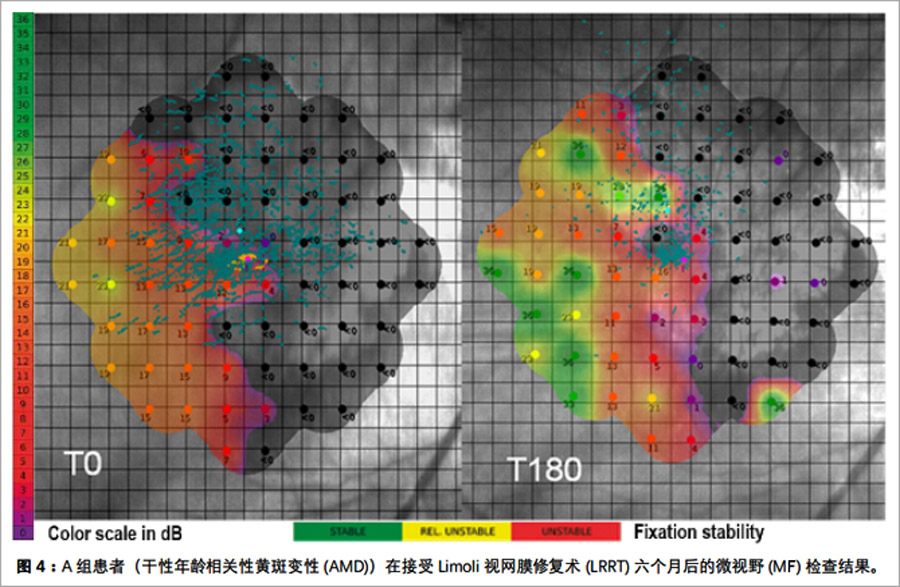 黄斑变性临床试验
