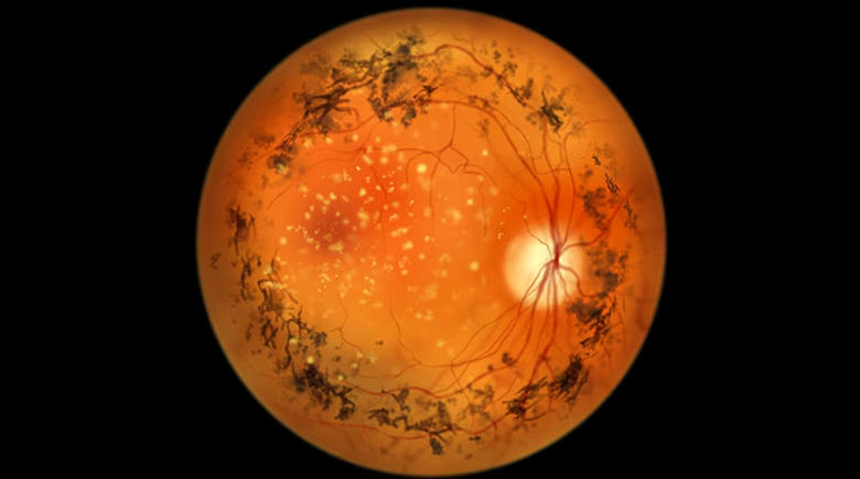 干细胞治疗视网膜色素变性3期临床试验：术后82例患者视力、视野和视网膜功能均显著改善