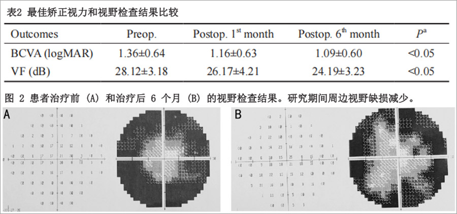 视网膜色素变性临床试验