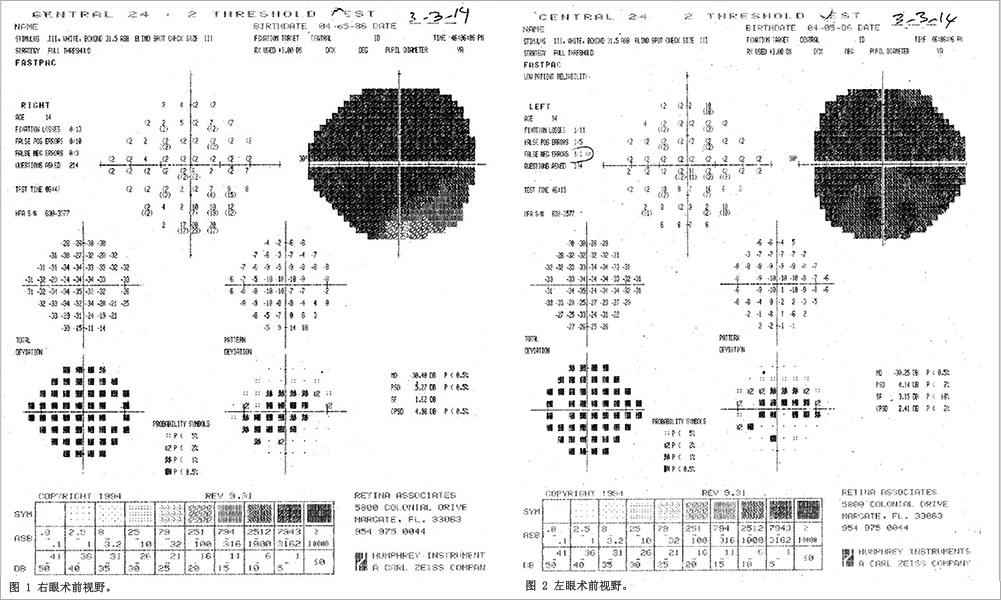视神经病变临床试验