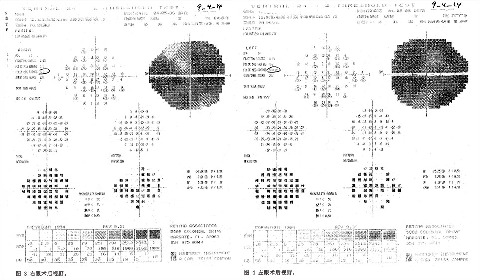 视神经病变临床试验