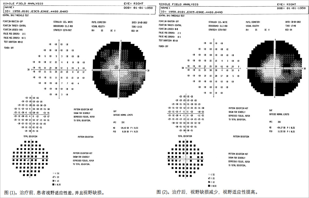 视网膜色素变性临床试验
