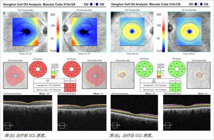 视网膜色素变性临床试验