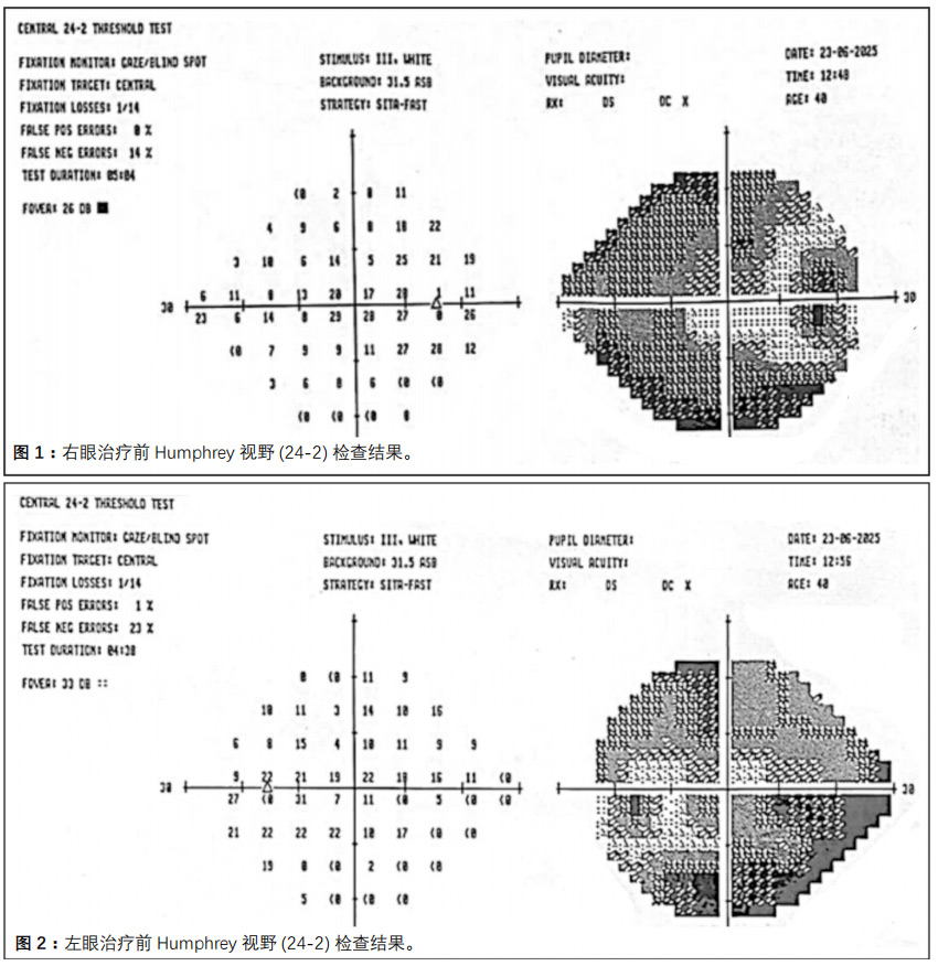 视神经炎临床试验