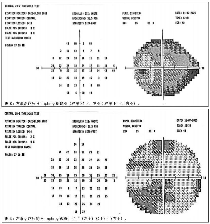 视神经炎临床试验