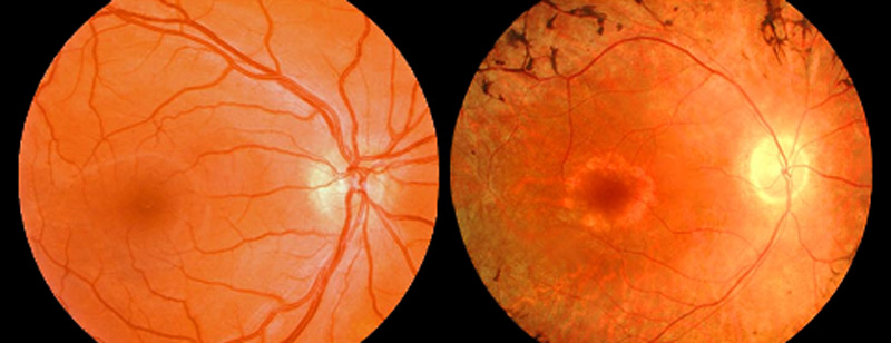 视网膜色素变性