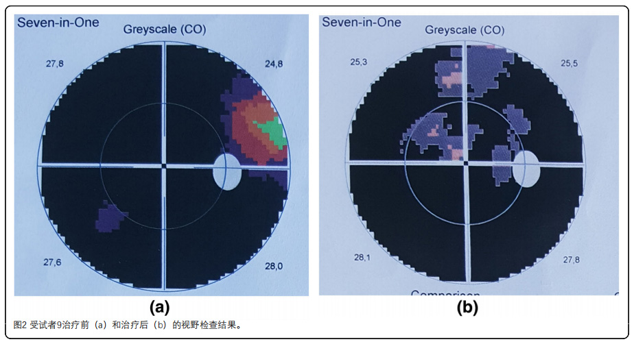 视网膜色素变性临床试验