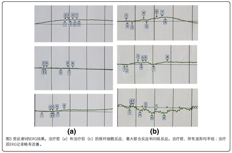 视网膜色素变性临床试验