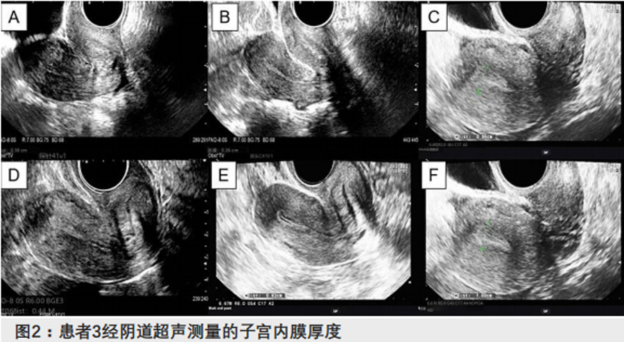 薄子宫内膜临床试验