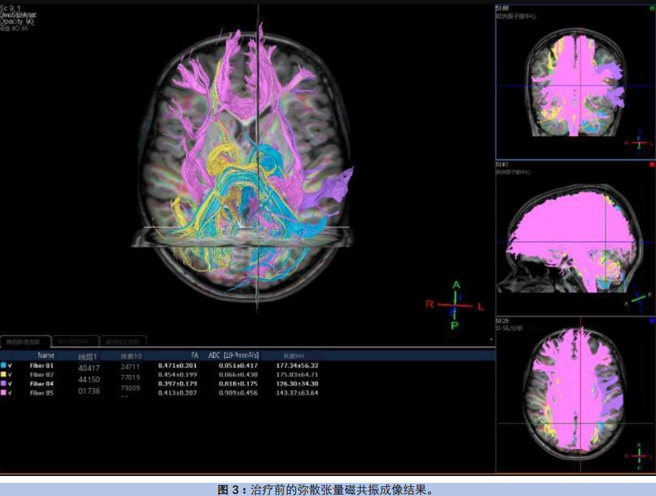 干细胞疗法治疗自闭症
