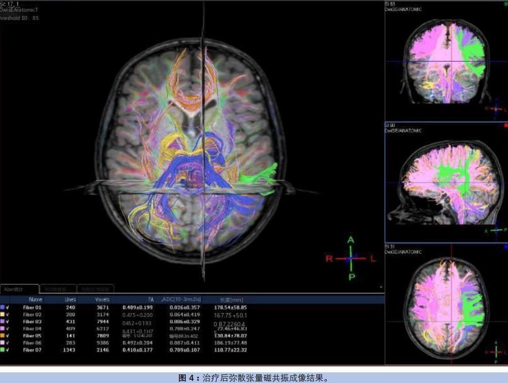 干细胞疗法治疗自闭症