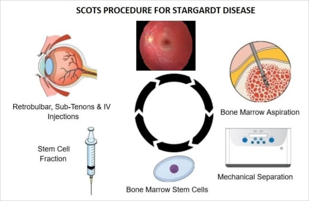 斯塔加特病临床试验