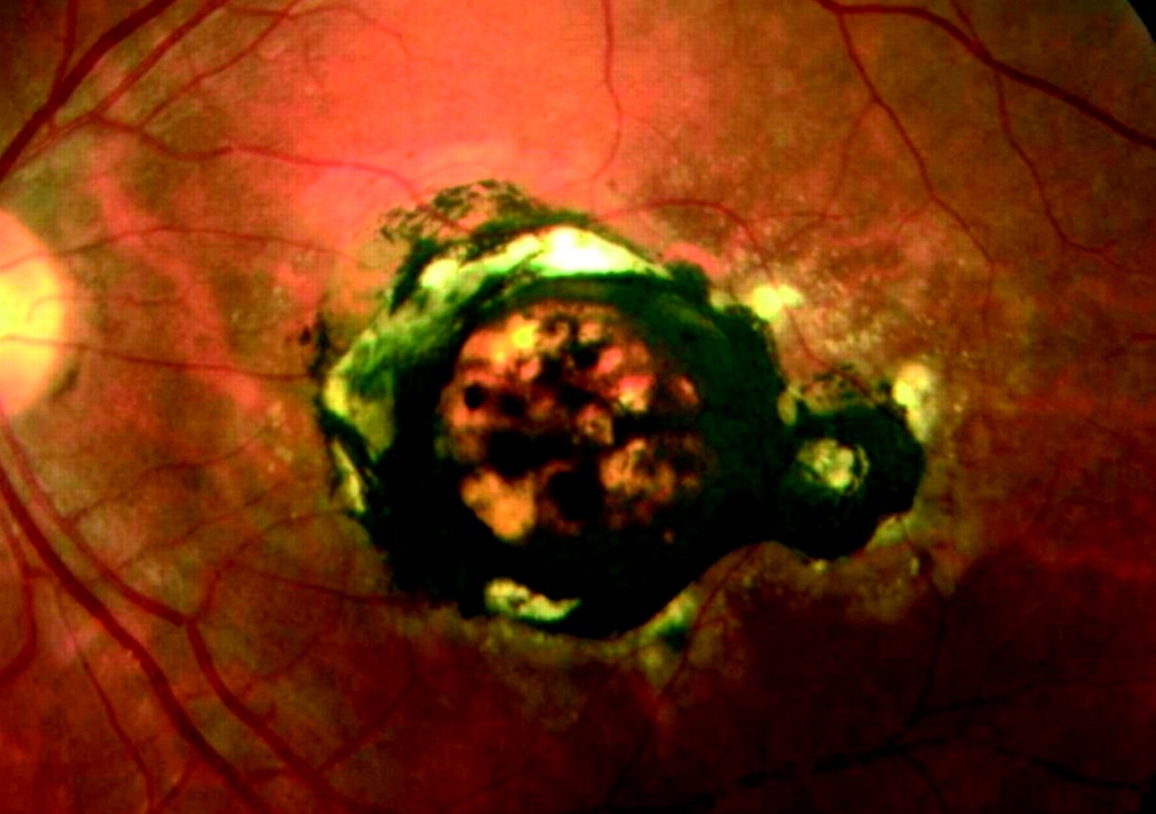 自体骨髓干细胞治疗遗传性黄斑变性病例报告：术后14个月患者从法定盲恢复正常用眼视力