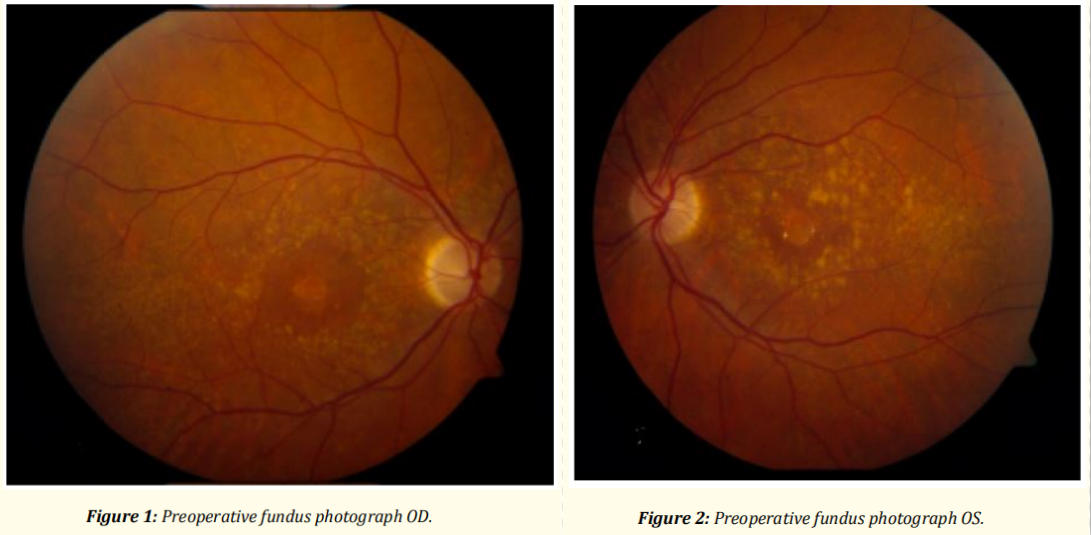 遗传性黄斑变性临床研究