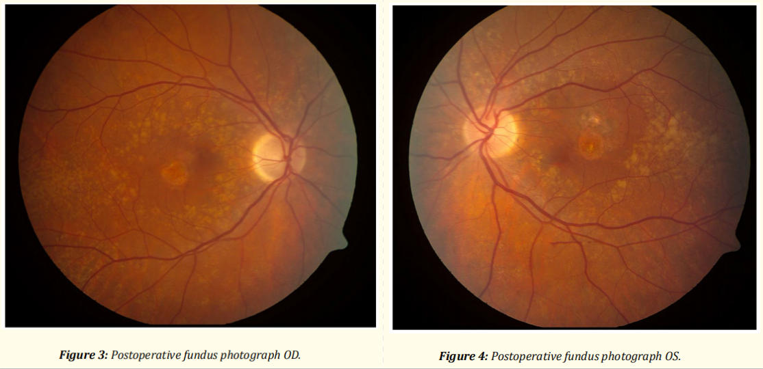 遗传性黄斑变性临床研究
