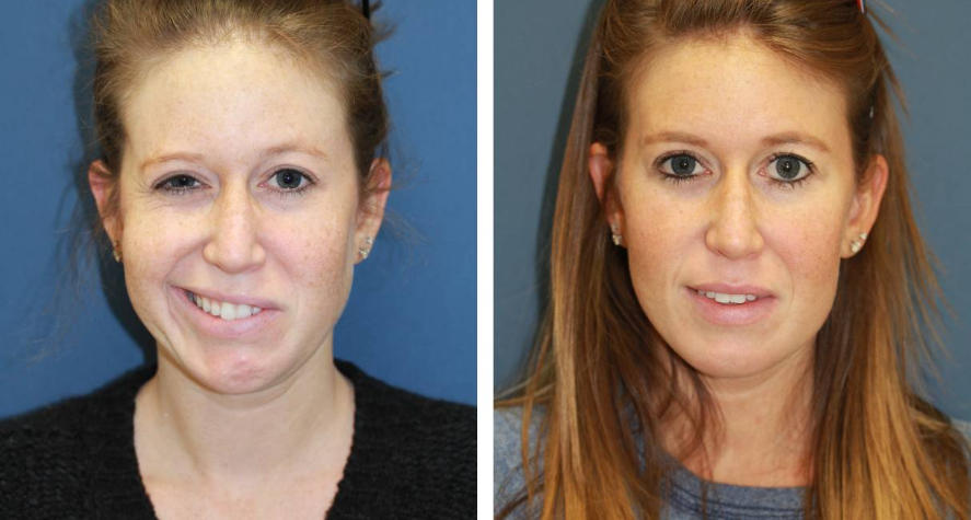 7年特发性面瘫患者局部注射8次干细胞：32个月后面部功能完全康复且无复发