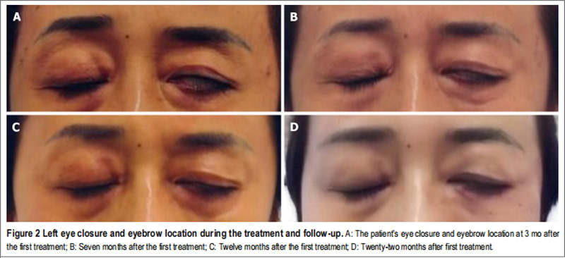 特发性面瘫临床研究