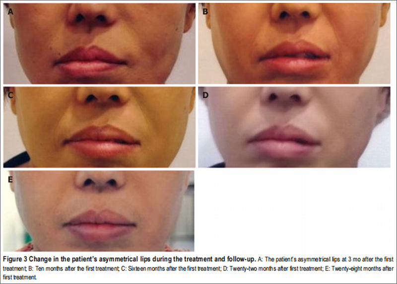特发性面瘫临床研究