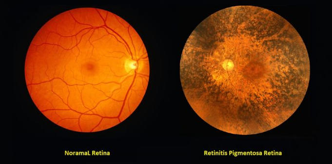 自体骨髓谱系阴性细胞治疗RP：12个月随访，56.7%患者视功能显著改善，病程短者获益更佳！