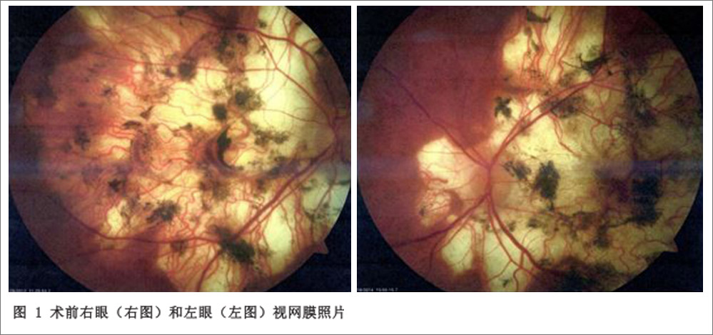 干细胞治疗后葡萄膜炎