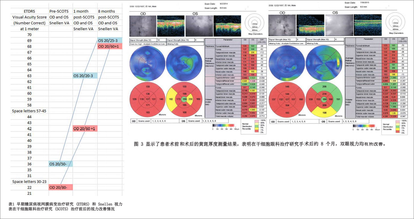 干细胞治疗后葡萄膜炎