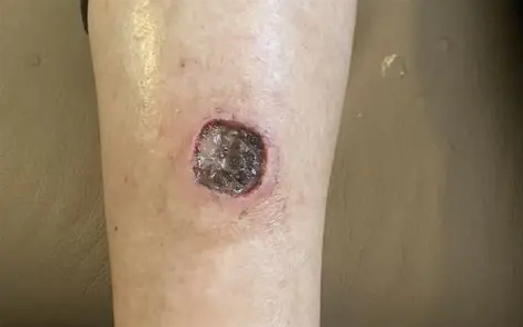 自体脂肪干细胞治疗20例严重肢体缺血溃疡：临床验证安全有效，截肢风险显著降低