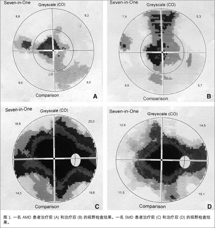 黄斑病变临床研究