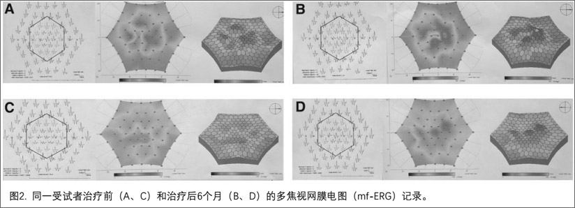 黄斑病变临床研究