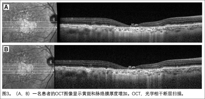 黄斑病变临床研究