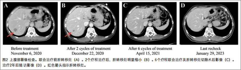 直肠癌临床研究