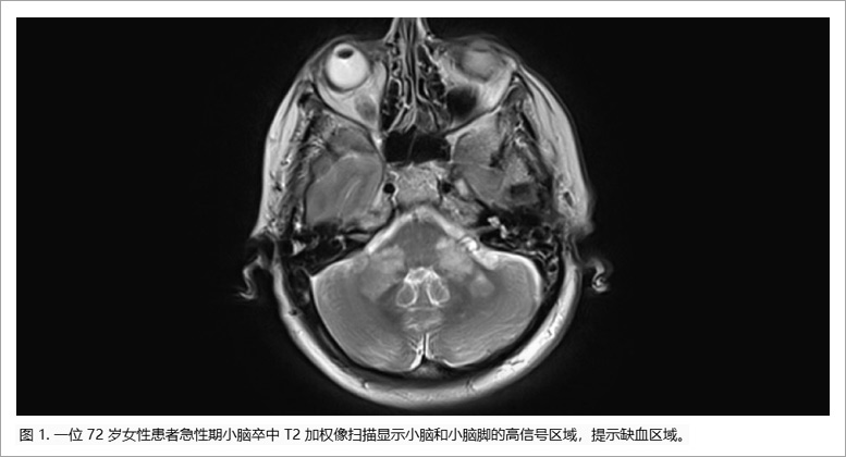 缺血型卒中临床研究