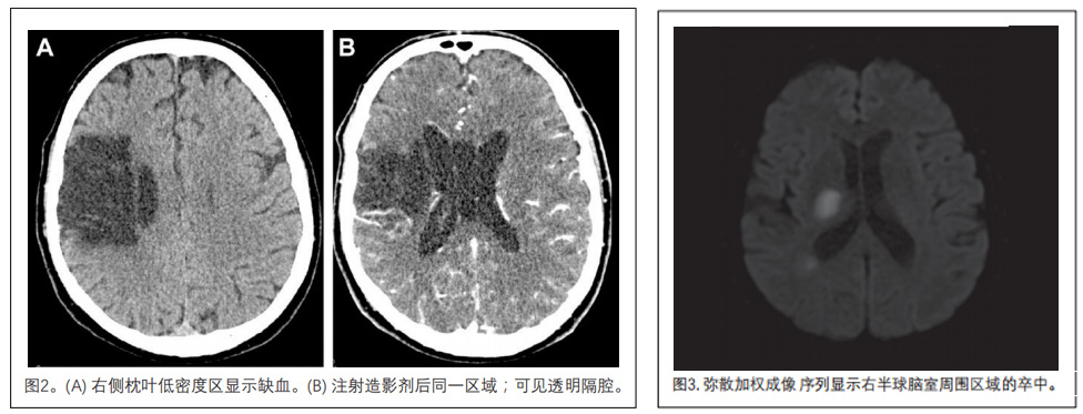 缺血型卒中临床研究