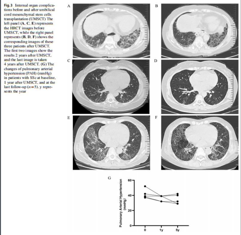 系统性硬化症临床研究
